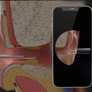 SMART EARWAX REMOVAL